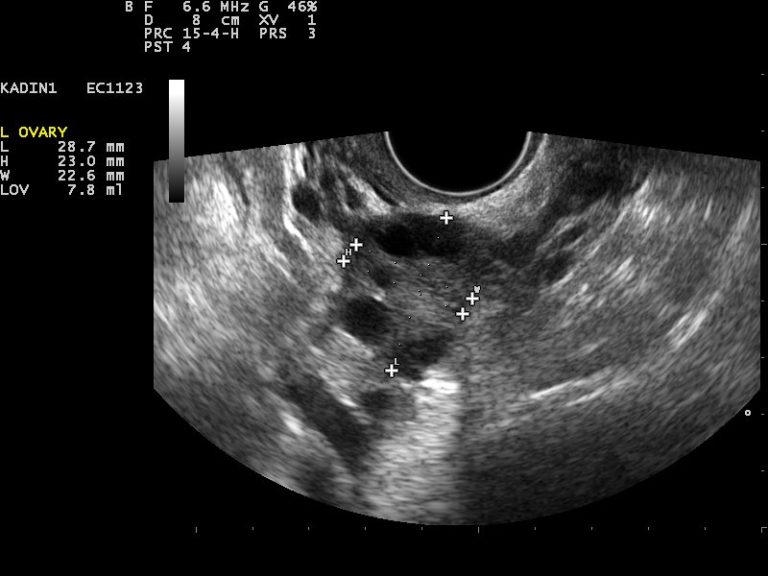 Eierstockkrebs: Warum Frauenärzte auf dem Ultraschall beharren - MedWatch