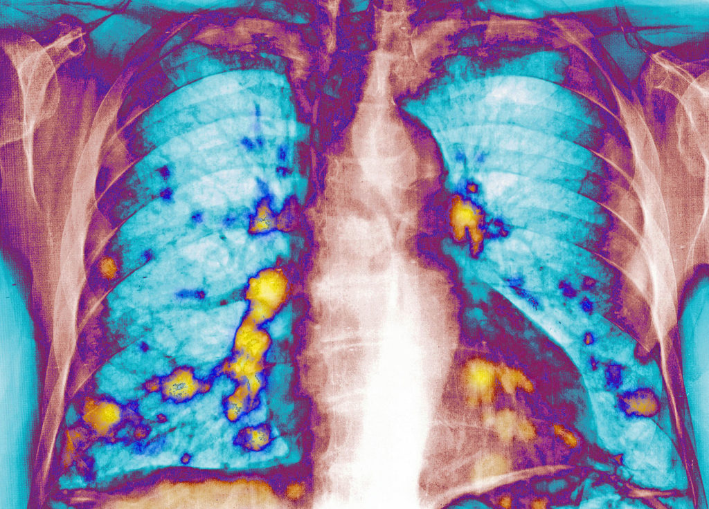 Lungenmetastasen auf einem Röntgenbild.