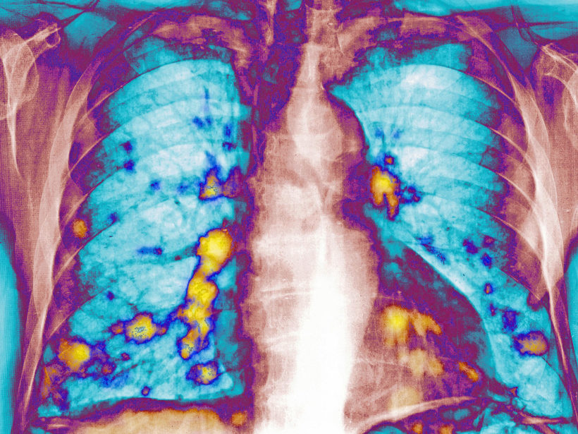 Lungenmetastasen auf einem Röntgenbild. (Photo: Getty Images)