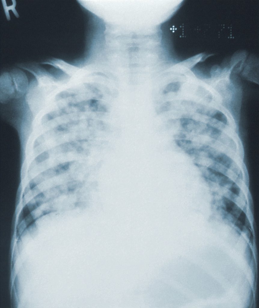 Röntgenbild eines Bruskorbs