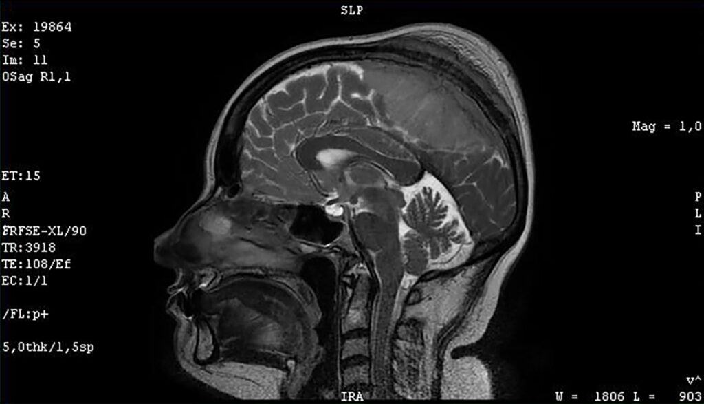MRT-Bildgebung eines menschlichen Kopfes mit Kontrastmittel.